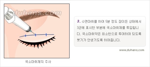 ​[두한성형외과 경쟁력 눈성형] - [자연스럽고 아름다운 쌍꺼풀의 기준] 관련 이미지 9