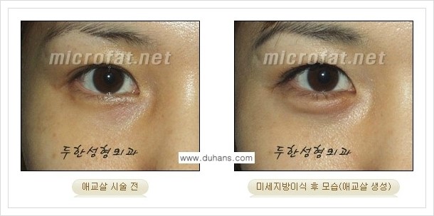 [두한성형외과 경쟁력 눈밑성형] - [눈밑 애교살 미세지방이식 안내] 관련 이미지 2