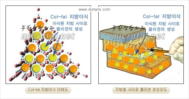 [두한성형외과 상표특허 "Col-fat(콜펫) 지방이식"] - [Col-fat(콜펫) 지방이식이란?] 관련 이미지 4