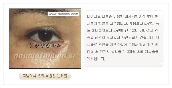 [두한성형외과 경쟁력 쌍꺼풀 재수술, 극한 재수술] - [쌍꺼풀 재수술의 과정 안내 2.] 관련 이미지 2