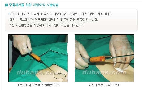 [두한성형외과 경쟁력 주름성형] - [주름 교정을 위한 안전하고 효과적인 미세지방이식] 관련 이미지 2