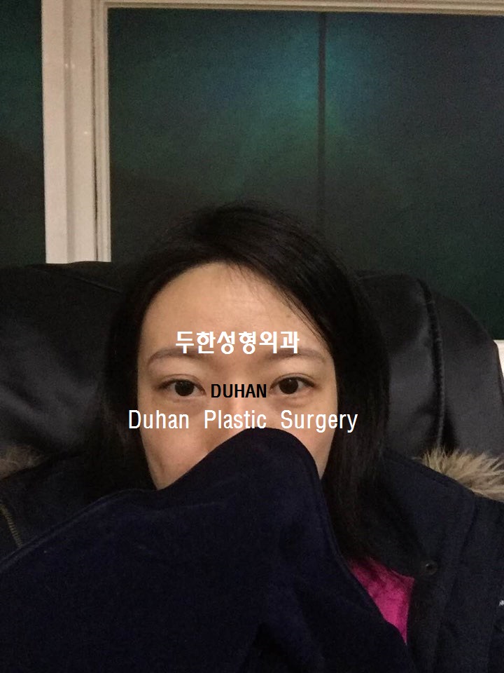 #극한눈재수술  #쌍꺼풀재수술 #눈수술입니다. #외반교정 #안검퇴축 관련 이미지 4