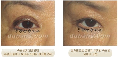 두한성형외과 눈재수술 - 쌍꺼풀 재수술 방법 관련 이미지 44
