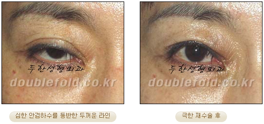 [DoubleFold Plastic Surgery Eye Surgery] - [Revision Surgery for Thick Double Eyelids] image 32