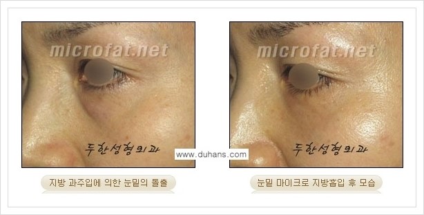 [두한성형외과 겨울엔 지방흡입을] - [볼살, 눈밑, 턱선의 초음파 미세지방흡입 1.] 관련 이미지 5