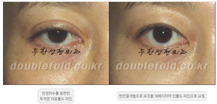 [Double Eyelid Surgery Duhan Plastic Surgery] - [Revision Methods] image 6
