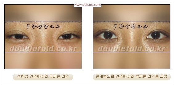 [두한성형외과 경쟁력 눈성형] - [극한 재수술, 함몰된 눈꺼풀 라인교정, 안검하수(졸리운 눈매)] 관련 이미지 105