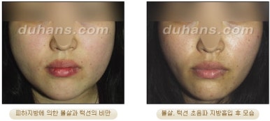 [두한성형외과 안전한 지방흡입] - [얼굴지방흡입] 관련 이미지 16