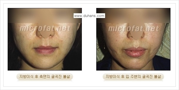 ​[두한성형외과 경쟁력 미세지방이식] - [타병원에서의 미세지방이식 부작용 종류와 문제점 안내] 관련 이미지 10