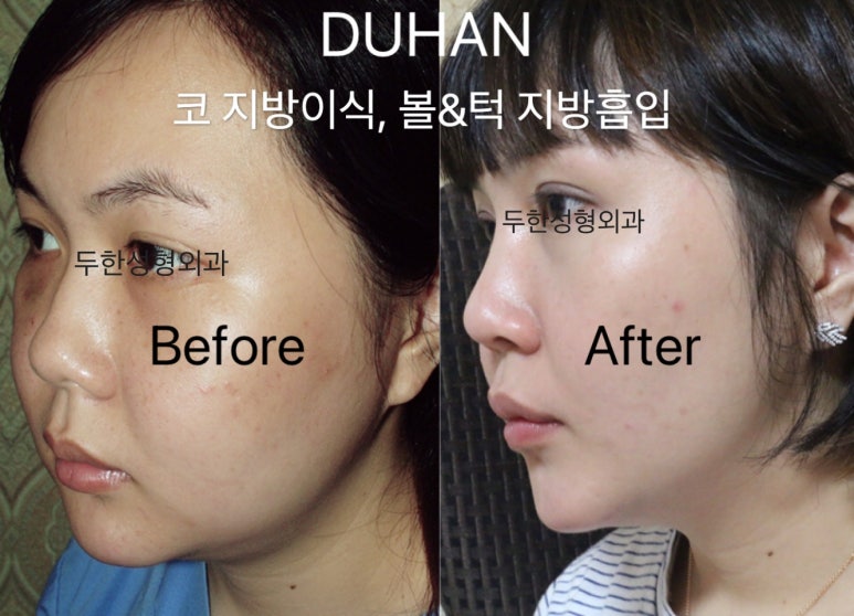 Naturally Beautifying! A Case Introduction of Nose Fat Grafting + Cheek & Chin Liposuction image 1