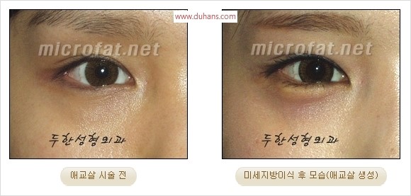 ​﻿[두한성형외과 경쟁력 지방이식] - [눈밑 애교살 시술을 위한 미세지방이식] 관련 이미지 8