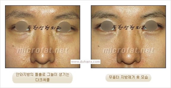 ⁠⁠[두한성형외과 경쟁력 안검성형] - [젊은 눈매를 위한 윗눈꺼풀 지방제거, 눈밑 지방제거] 관련 이미지 27