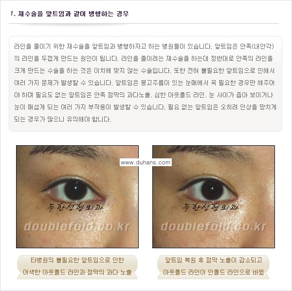[두한성형외과 경쟁력 쌍꺼풀 재수술, 극한 눈재수술] - [쌍꺼풀 재수술, 눈 재수술의 실패 원인] 관련 이미지 1