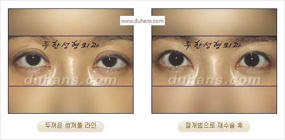 [두한성형외과 경쟁력 눈성형] - [나에게 맞는 어울리는 쌍꺼풀 라인] 관련 이미지 6