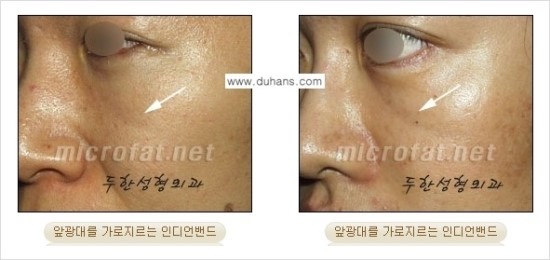 [두한성형외과 경쟁력 귀족성형] - [3차원 입체 미세지방이식 귀족수술 + 인디언밴드 교정] 관련 이미지 6