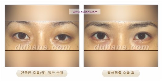 [두한성형외과 경쟁력 눈성형] - [자연스럽고 아름다운 눈매를 만드는 여러 가지 눈성형 방법] 관련 이미지 13