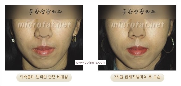 [두한성형외과 경쟁력 미세지방이식] - [볼살, 이마, 측두부 - 안면윤곽 미세지방이식] 관련 이미지 7