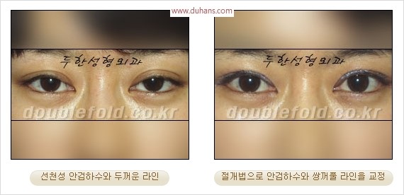 [두한성형외과 경쟁력 눈성형] - [극한 재수술, 함몰된 눈꺼풀 라인교정, 안검하수(졸리운 눈매)] 관련 이미지 106
