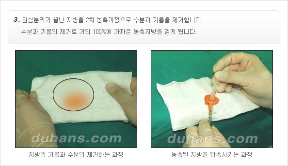 [두한성형외과 경쟁력 주름성형] - [주름 교정을 위한 안전하고 효과적인 미세지방이식] 관련 이미지 4