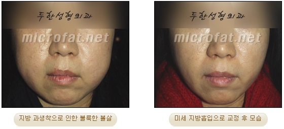 얼굴지방이식 두한성형외과 - 볼지방이식 관련 이미지 45