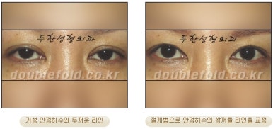 [Duhan Plastic Surgery Double Eyelid Revision Surgery] - [Ptosis, sausage eyelids] image 20