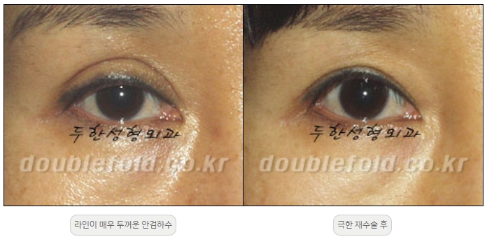 [Double Eyelid Surgery, Duhan Plastic Surgery] - [Extreme Revision Eye Surgery to Correct a Damaged Line] image 28