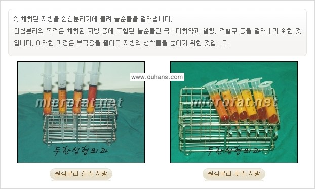[두한성형외과의 경쟁력 미세지방이식] - [이마 미세지방이식 안내 ①] 관련 이미지 7