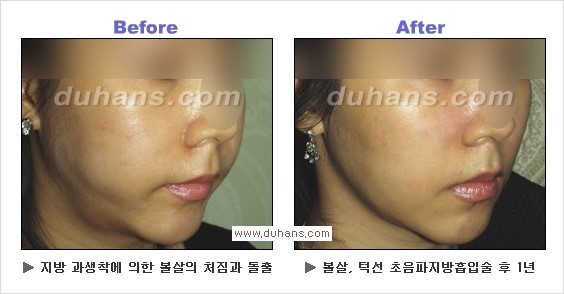 [두한성형외과 경쟁력 얼굴지방흡입] - [통통한 볼살, 두툼한 턱살(턱선)의 지방흡입] 관련 이미지 14