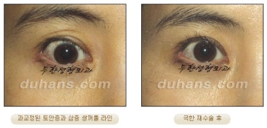 [Special Double Eyelid Revision Surgery at Duhan Plastic Surgery] - [Restorative Surgery for Damaged Double Eyelid Eye Shape] image 16