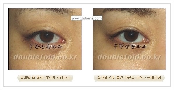 [두한성형외과 경쟁력 쌍꺼풀 재수술, 극한 재수술] - [쌍꺼풀 라인이 풀렸을 경우 쌍꺼풀 재수술 안내] 관련 이미지 2