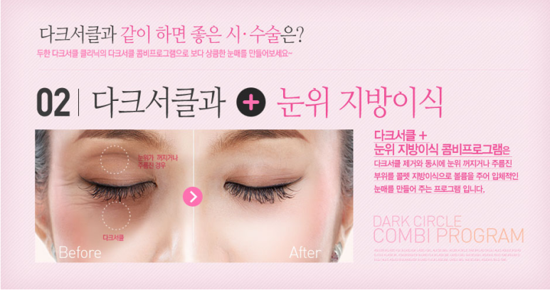 🌟 눈성형 가이드 &ndash; 쌍커풀&middot;재수술&middot;눈위/눈밑 지방이식 관련 이미지 2