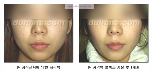 [두한성형외과 경쟁력 안면윤곽 성형 리더] - [완변한 V 라인! 턱 미세지방이식, 볼살 미세지방이식, 사각턱 보톡스 안내] 관련 이미지 33