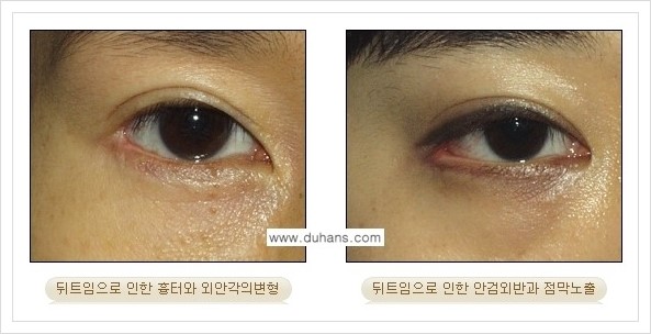 [두한성형외과 경쟁력 쌍꺼풀 재수술, 극한 눈재수술] - [뒤트임 수술의 부작용 및 교정 방법 안내] 관련 이미지 8