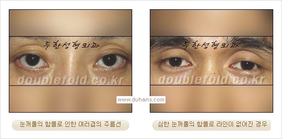​⁠⁠[두한성형외과 경쟁력 쌍꺼풀 재수술, 극한 눈재수술] - [지방이식으로 눈매와 쌍꺼풀 라인을 교정] 관련 이미지 3