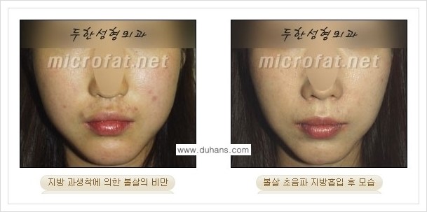 [두한성형외과 겨울엔 지방흡입을] - [볼살, 눈밑, 턱선의 초음파 미세지방흡입 2.] 관련 이미지 13