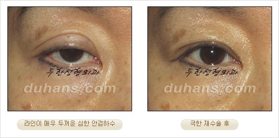 [두한성형외과 경쟁력 쌍꺼풀 재수술 리더 ] - [쌍꺼풀 재수술 과정, 쌍꺼풀 재수술 실패의 원인, 극한 재수술] 관련 이미지 23