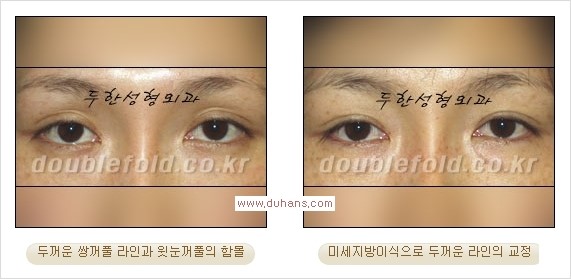 [두한성형외과 경쟁력 쌍꺼풀 재수술] - [쌍꺼풀 재수술 과정] 관련 이미지 94