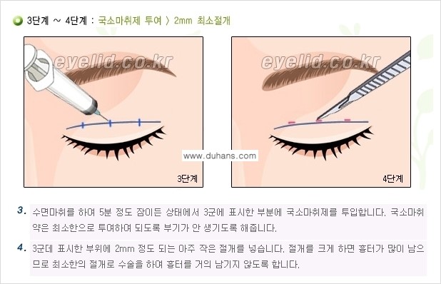 [두한성형외과 경쟁력 눈성형] - [퀵쌍꺼풀(부분절개법) 수술 안내] 관련 이미지 13