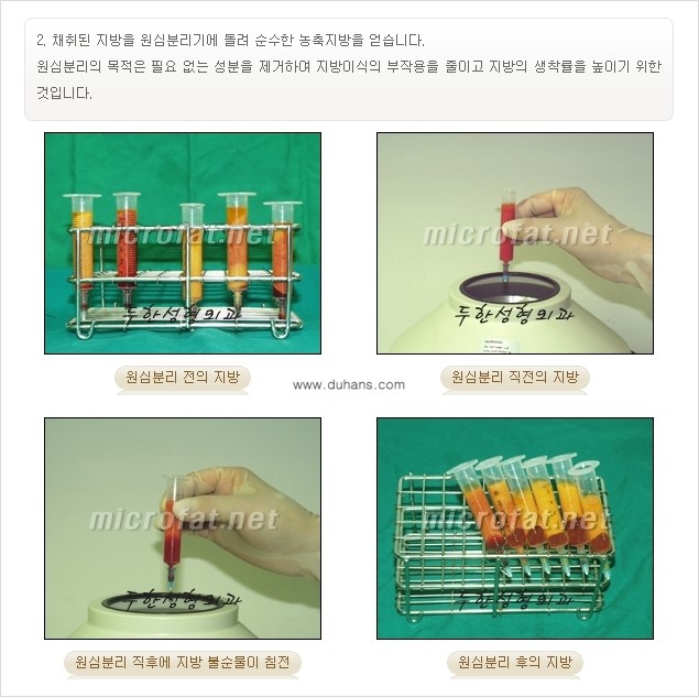 [두한성형외과 "미세지방이식"] - [지방이식 부작용 교정 정보 ②] 관련 이미지 7