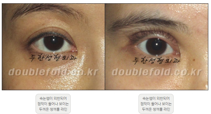 [Double Eyelid Surgery Duhan Plastic Surgery] - [Revision Methods] image 31
