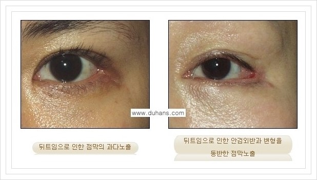 [두한성형외과 경쟁력 쌍꺼풀 재수술, 극한 재수술] - [뒤트임 수술에 대한 안내] 관련 이미지 10