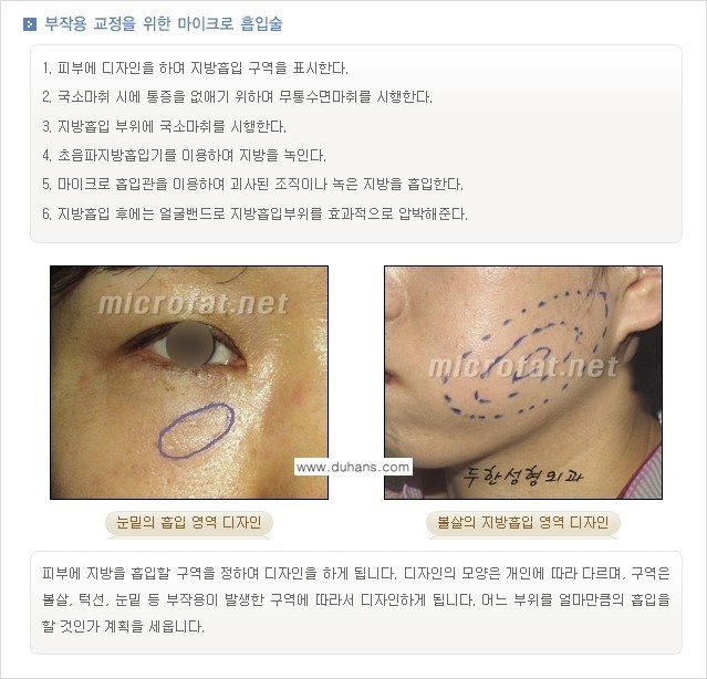 ​[두한성형외과 경쟁력 미세지방이식] - [지방이식 부작용 교정 안내 ②] 관련 이미지 2