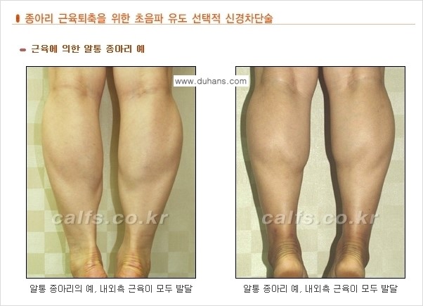 [두한성형외과 날씬한 종아리 만들기!] - [종아리 성형 안내 1.] 관련 이미지 3
