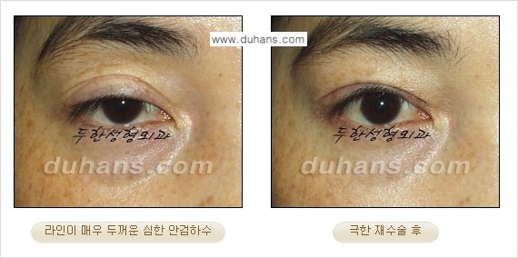 [두한성형외과 경쟁력 눈성형] - [두꺼운 라인을 교정하는 극한 눈 재수술 1.] 관련 이미지 15