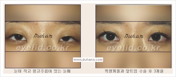 [두한성형외과 경쟁력 눈성형] - [퀵쌍꺼풀(부분절개법) 안내] 관련 이미지 5