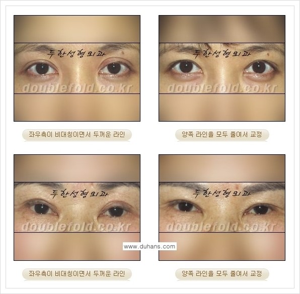 [두한성형외과 경쟁력 쌍꺼풀 재수술] - [짝짝이(비대칭) 쌍꺼풀 라인 교정하는 방법 안내 2.] 관련 이미지 4