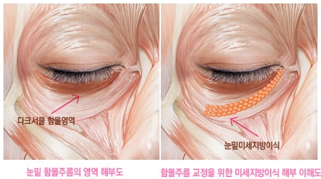 [두한성형외과 다크서클] - [다크서클 콜펫지방이식] 관련 이미지 18