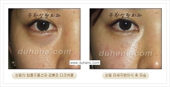 [두한성형외과 경쟁력 눈밑성형] - [꺼진 눈밑, 눈밑 함몰 주름선 눈밑 미세지방이식 안내] 관련 이미지 9