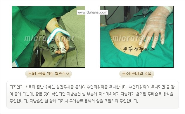 [두한성형외과 겨울엔 지방흡입 도전] - [간편한 복부지방흡입 1.] 관련 이미지 8