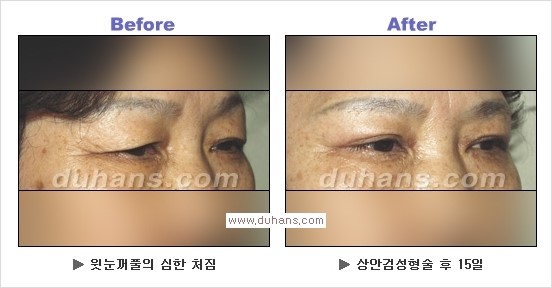 [두한성형외과 경쟁력 눈성형] - [상큼하고 환한 눈매! 상안검 성형(윗눈꺼풀 처짐) 안내] 관련 이미지 11